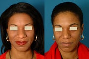 African American Rhinoplasty