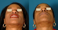 African American Rhinoplasty