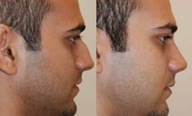 Rhinoplasty. 11 days after surgery.
