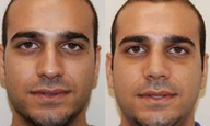 Rhinoplasty. 11 days after surgery