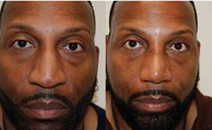 African-American Rhinoplasty Male Nose Job