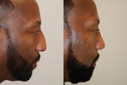 African-American Rhinoplasty: Profile view