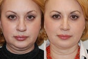 Rhinoplasty and Neck Liposuction