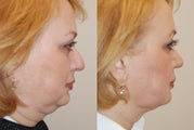 Rhinoplasty and Neck Liposuction, profile view