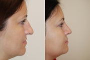 Rhinoplasty