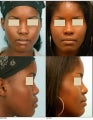 Rhinoplasty (Nose Job)