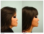 Asian Female Rhinoplasty