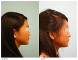 Asian Rhinoplasty