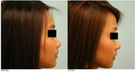 Asian Rhinoplasty