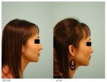 Asian Rhinoplasty