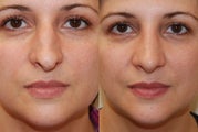 Rhinoplasty, 3 weeks post-op. Front view