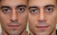 Rhinoplasty, 6 weeks post-op.