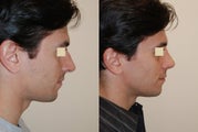 Rhinoplasty, 6 weeks post op.
