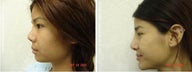 Rhinoplasty