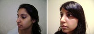 Rhinoplasty