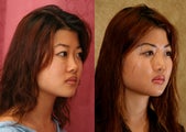 rhinoplasty- Asian