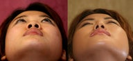 rhinoplasty- asian