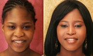 Rhinoplasty- African American