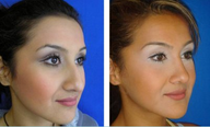 Rhinoplasty