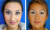 Rhinoplasty