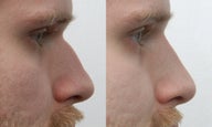 non-surgical rhinoplasty