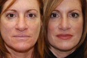 Rhinoplasty Surgery. 6-weeks post-op.