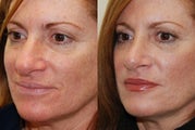 Rhinoplasty Surgery. 6-weeks post-op.