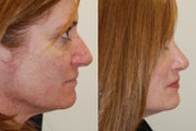 Rhinoplasty Surgery. 6-weeks post-op.