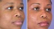 Nose reshaping