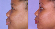 Nose Reshaping