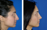 Rhinoplasty