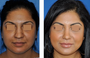 Rhinoplasty