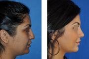 Rhinoplasty