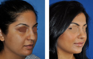 Rhinoplasty
