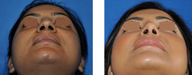 Rhinoplasty