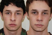 Rhinoplasty Surgery. 1 month post-op.