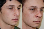 Rhinoplasty Surgery. 1 month post-op.