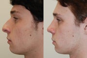 Rhinoplasty Surgery. 1 month post-op.
