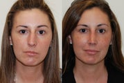 Rhinoplasty Surgery. 2 months post-op.