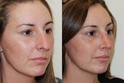 Rhinoplasty Surgery. 2 months post-op.