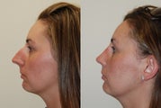Rhinoplasty Surgery. 2 months post-op.
