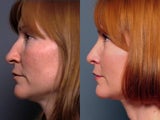 Rhinoplasty