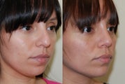 Rhinoplpasty Surgery. 4 months post-op.