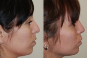 Rhinoplasty Surgery. 4 months post-op