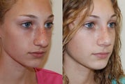 Rhinoplasty Surgery. 2 months post-op. 3/4 view.