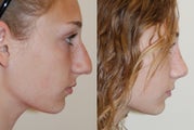 Rhinoplasty Surgery. 2 months post-op. Profile viiew.