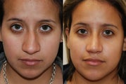 Rhinoplasty Surgery. 6 weeks post-op