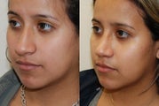 Rhinoplasty Surgery. 6 weeks post-op