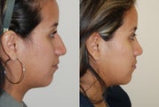 Rhinoplasty Surgery. 6 weeks post-op
