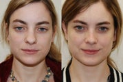 Rhinoplasty Surgery. 1 year post-op